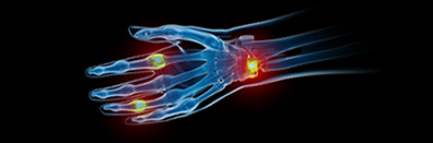 Correlation Evidence of Infection in Patients with Rheumatoid
                                                Arthritis